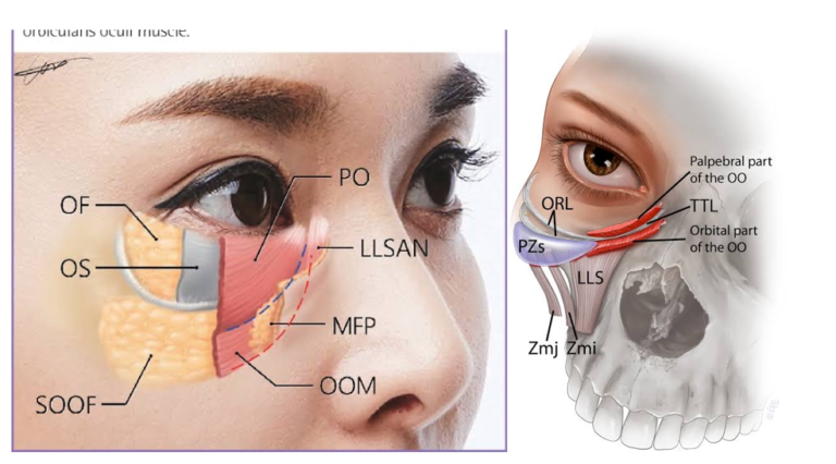 การฉีดฟิลเลอร์ใต้ตา (Tear trough Filler)