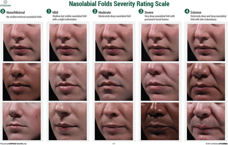 การฉีดฟิลเลอร์ร่องแก้ม (Nasolabial Fold Filler)